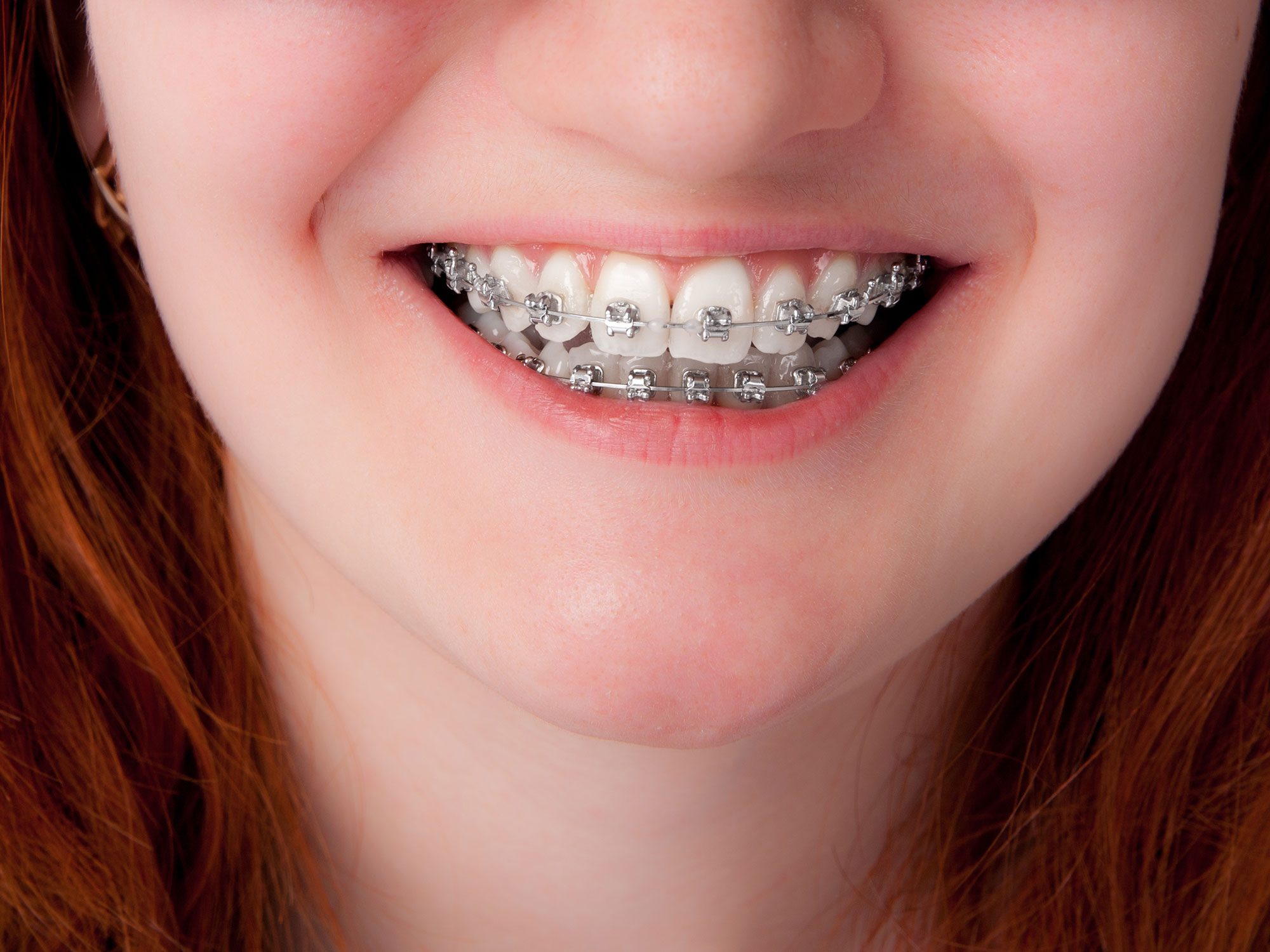 Braces For Young Kids Might Not Always Be Best : NPR