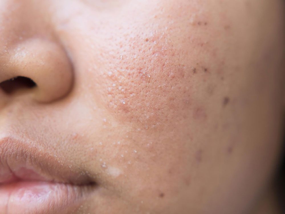 how-to-prevent-acne-scars-7-simple-tips-reader-s-digest-canada