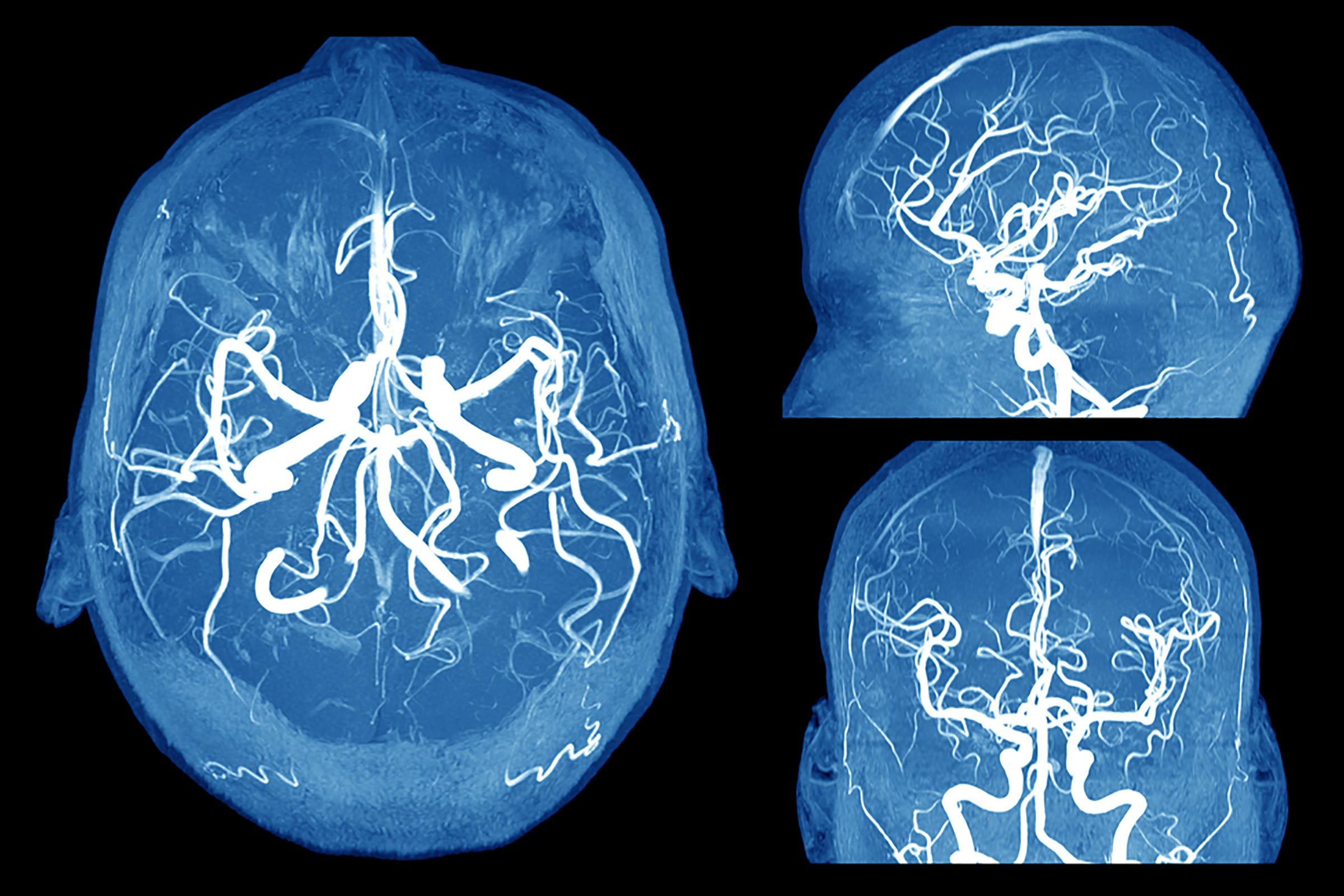 6 Signs Of A Brain Aneurysm Everyone Should Know Readers Digest 1791