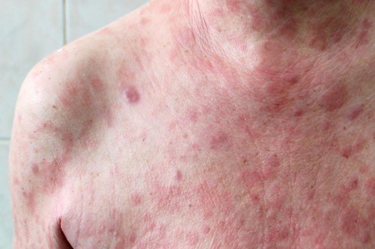 Skin Rashes And Cancer