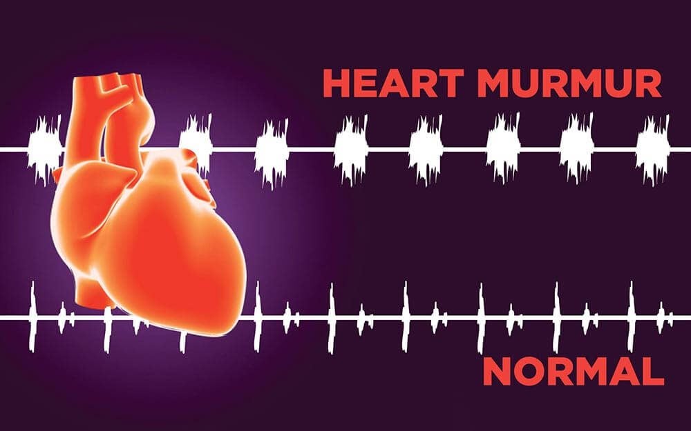 Heart Murmur Echocardiogram
