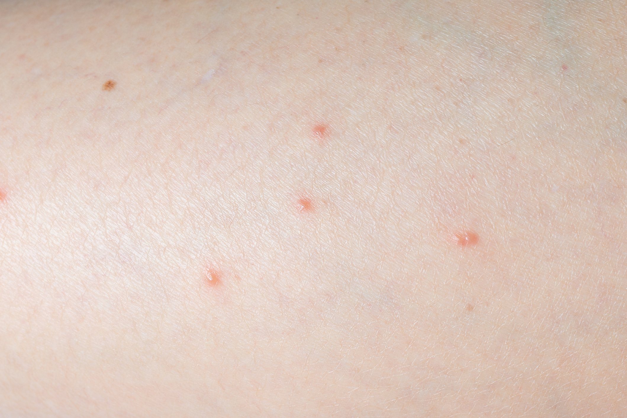 What Spider Bites Look Like—and When to Call the Doctor | RD.ca