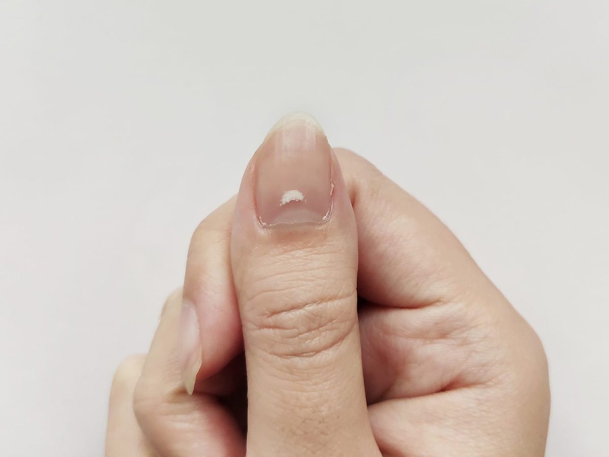 White Spot Nails Thumb ?w=1200