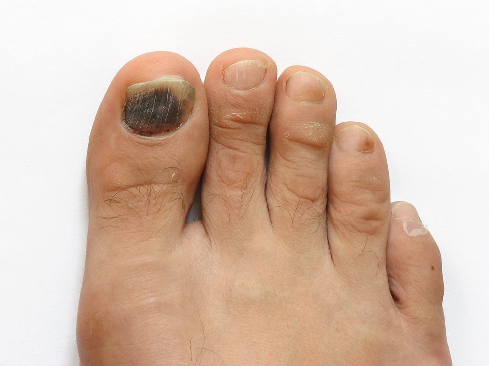 why-are-my-toenails-yellow-causes-and-treatment