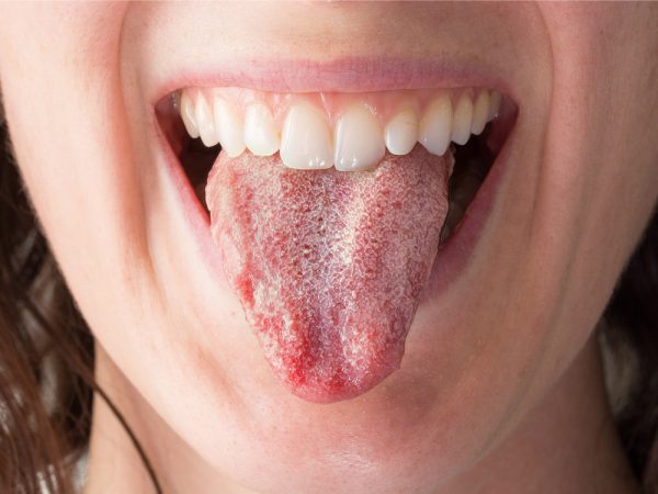 9 Surprising Secrets Your Tongue Can Reveal About Your Health