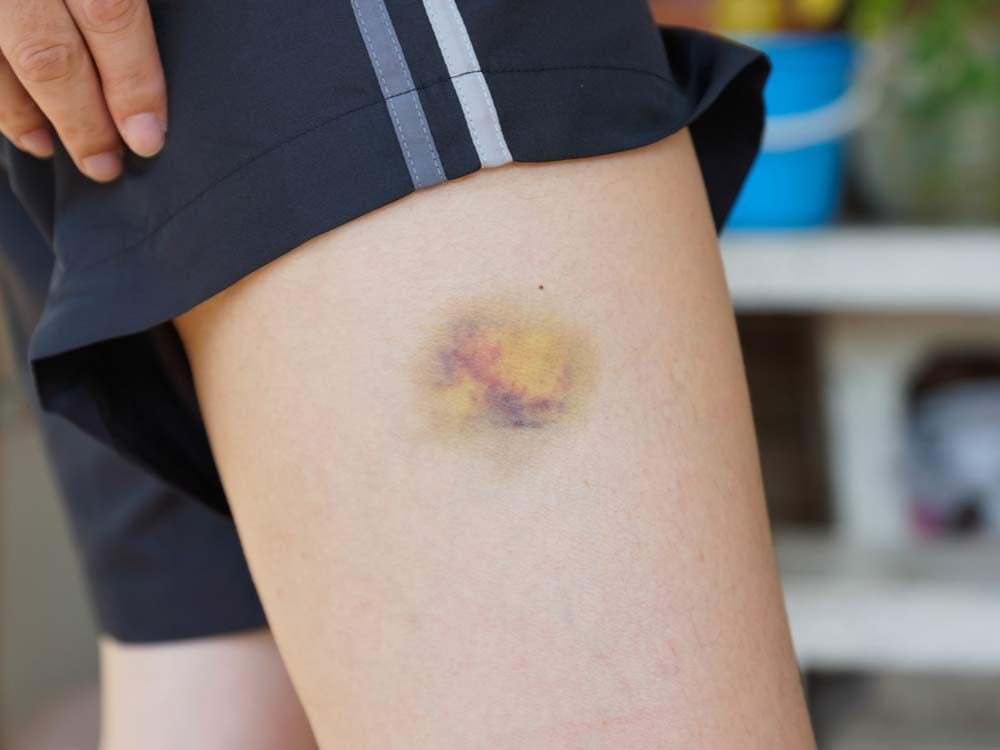 bruise-causes-diagnosis-treatment-home-remedy-and-healing-time