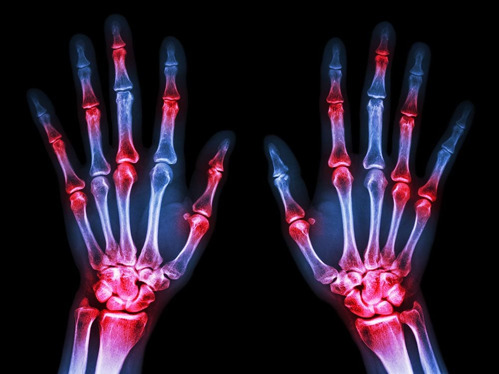 types-of-arthritis-you-could-have-and-how-to-tell-the-difference