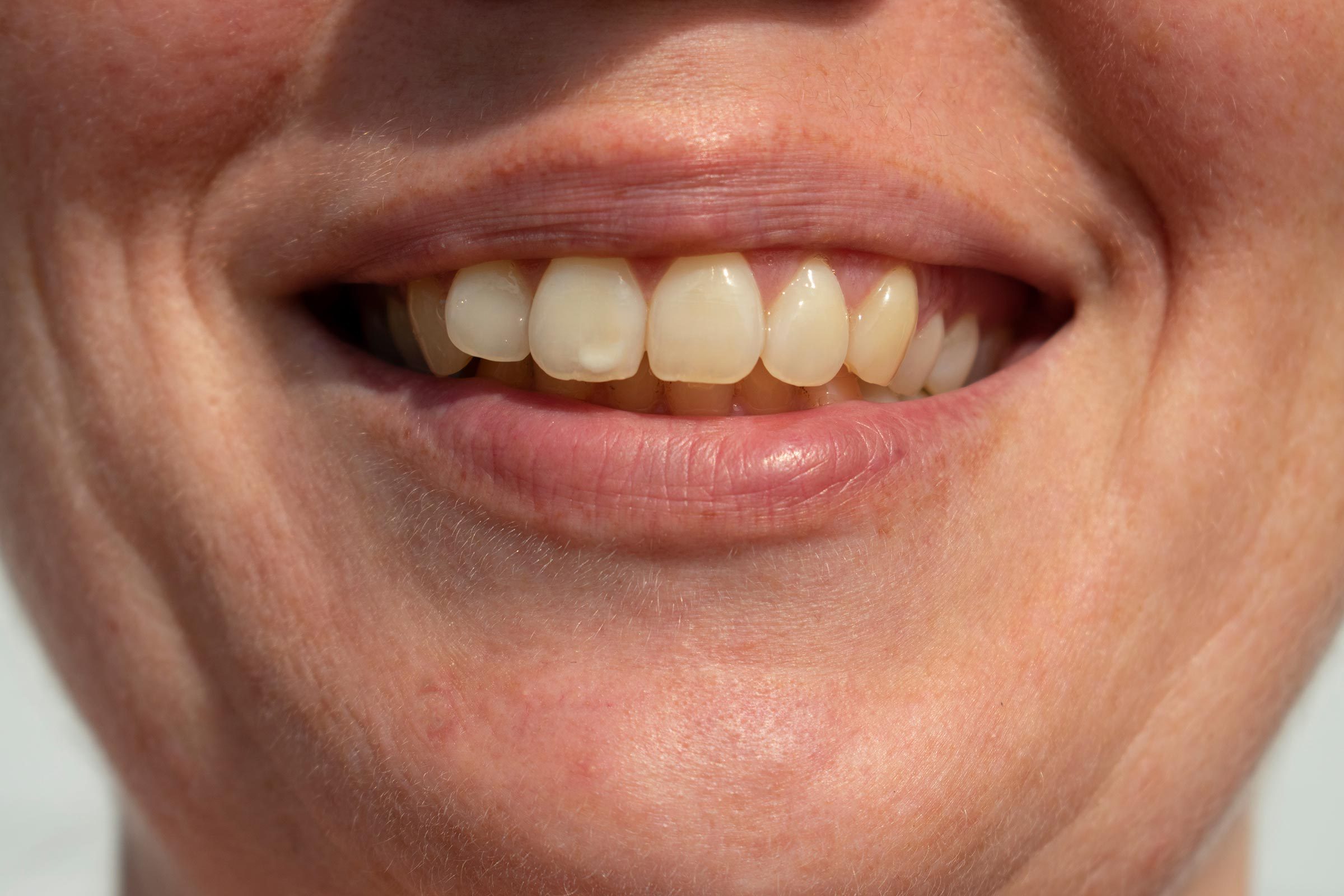 why-do-i-have-white-spots-on-my-teeth-peninsula-orthodontics