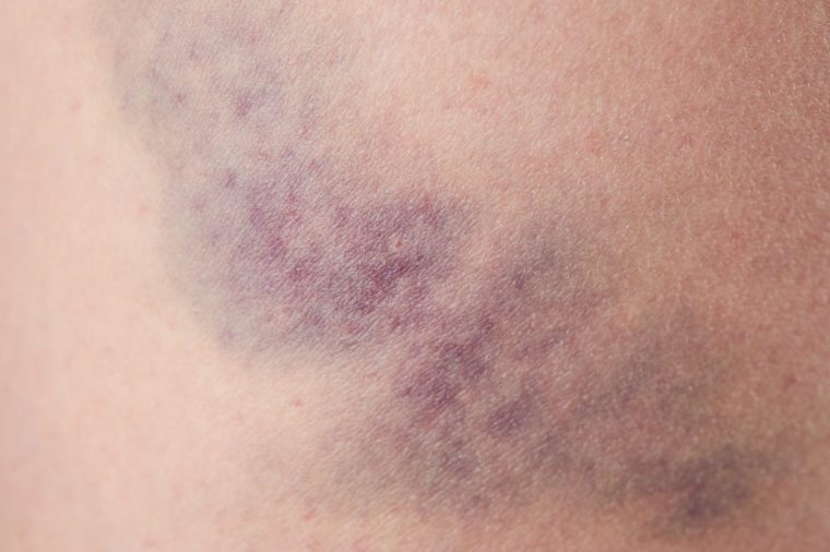 What Cancer Causes Excessive Bruising